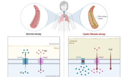 Cystic Fibrosis: Beyond the Lungs and into the Gut