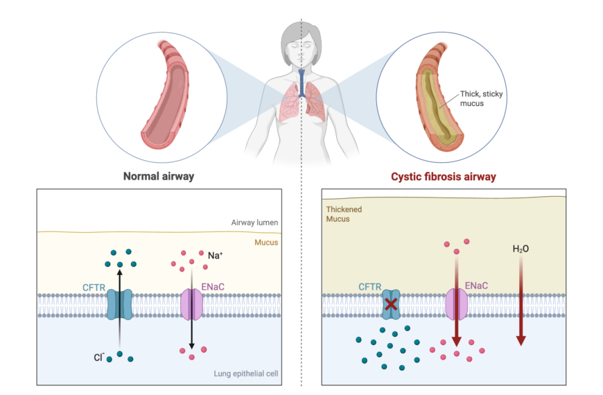 Cystic Fibrosis: Beyond the Lungs and into the Gut