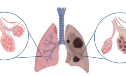 Fibrosis