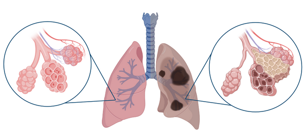 Fibrosis